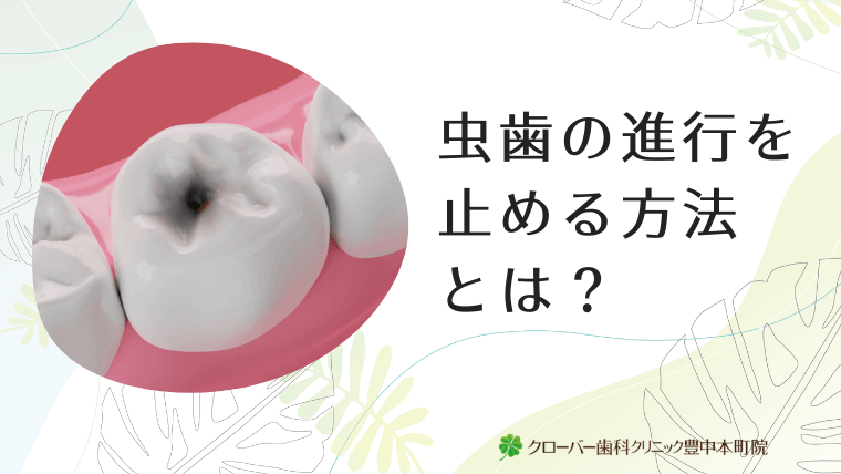 虫歯の進行を止める方法とは？